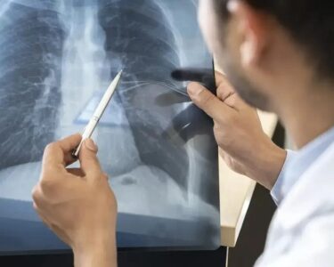 Anvisa aprova novo medicamento para câncer de pulmão avançado